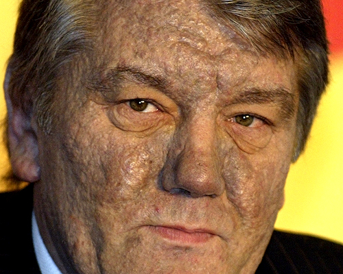 Ukrainian opposition presidential candidate Viktor Yushchenko, his face disfigured by illness, was found to have been poisoned with dioxin. Yushchenko said that he was sure he was poisoned by the Ukrainian government, and said he believes he was poisoned at a Sept. 5 dinner with the head of the Ukrainian security service and his deputy.