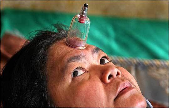 Cambodian immigrant Heap You continues to use the traditional 'cupping' treatment she learned in her homeland, believing it allows harmful 'excess wind' to escape her body. Mental health professionals have long been skeptical of such techniques, but some are becoming more open to including them along with Western treatments. With cupping, a small heated glass is placed upside-down on the skin. As the air inside it cools, it creates a vacuum that draws some of the skin into the cup, leaving a welt.