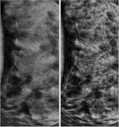 New software developed by Rhode Island company Advanced Image Enhancement, or AIE, is designed to give doctors more detail when they are looking at images such as mammograms and X-rays, ideally to improve diagnosis and treatment of breast cancer and other ailments. Pictured: Standard imaging of a mammogram (left) compared with the same mammogram performed by AIE.