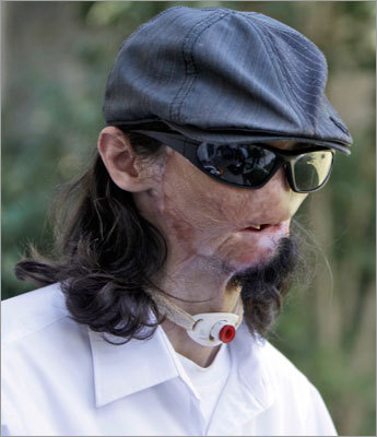 Brigham and Women’s Hospital surgeons made history on March 22, 2011, by performing the first full face transplant in the United States, attaching a donor's face to Dallas Wiens, 25, (shown) who suffered severe burns in a horrific electrical accident in 2008. Here's a look at other history-making transplants.