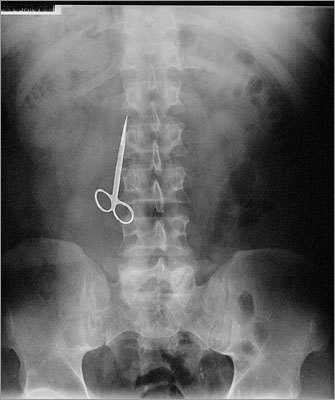 Surgeons are supposed to count all clamps that they put into the body and count them again when they remove them. Nevertheless, some clamps, like this hemostat used to control bleeding, sometimes get left inside accidentally.