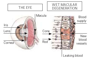 Wet macular degeneration