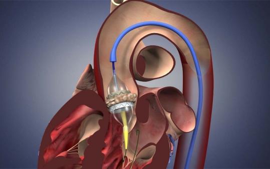 Clogged Aorta